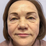 Круговая блефаропластика - до