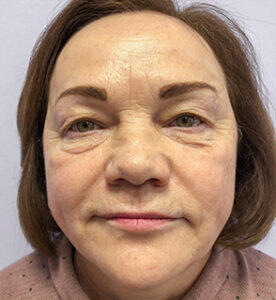 Круговая блефаропластика - до