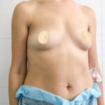 Увеличение груди - до