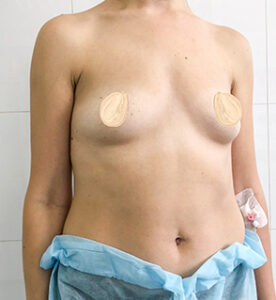 Увеличение груди - до