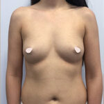 Увеличение груди - до