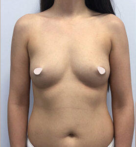 Увеличение груди - до