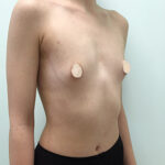 Увеличение груди - до