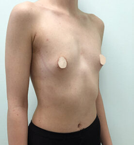 Увеличение груди - до