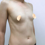 Увеличение груди - до