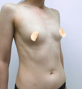 Увеличение груди - до