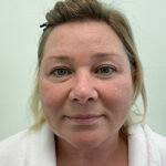 Круговая блефаропластика - до