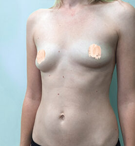 Маммопластика увеличение - до