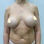 Реэндопротезирование груди - до