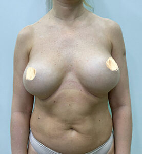 Реэндопротезирование груди - до