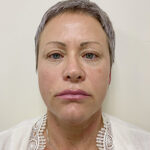 Круговая блефаропластика - до