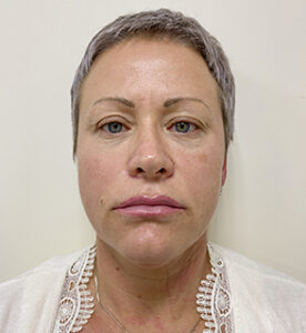 Круговая блефаропластика - до