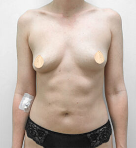 Коррекция асимметрии груди - до