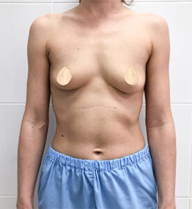 Коррекция асимметрии груди - до