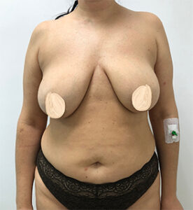 Коррекция асимметрии груди - до