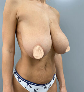 Уменьшение груди - до