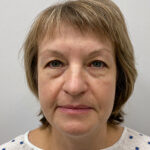 Круговая блефаропластика - до