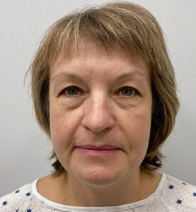 Круговая блефаропластика - до