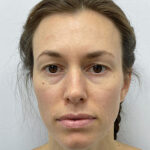 Круговая блефаропластика - до