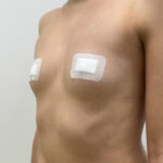 Маммопластика увеличение - до