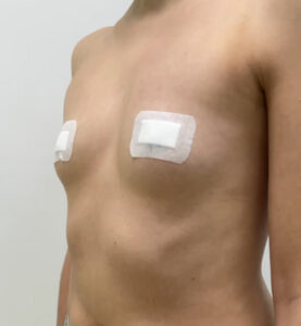 Маммопластика увеличение - до