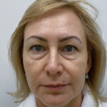 Нижняя блефаропластика - до