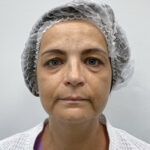 Круговая блефаропластика - до