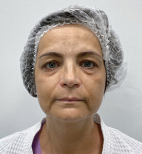 Круговая блефаропластика - до