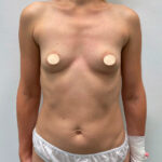 Маммопластика увеличение - до