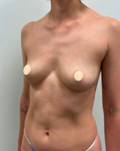 Маммопластика увеличение - до