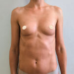 Маммопластика увеличение - до