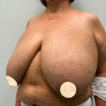 Редукционная маммопластика - до