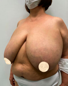 Редукционная маммопластика - до