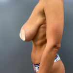 Редукционная маммопластика - до