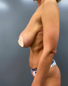 Редукционная маммопластика - до