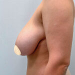 Редукционная маммопластика - до