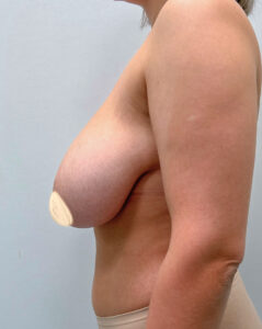 Редукционная маммопластика - до