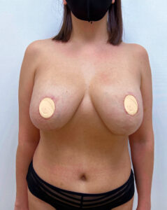 Реэндопротезирование - до