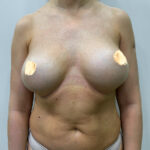 Реэндопротезирование - до