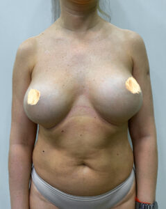 Реэндопротезирование - до