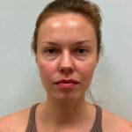 Нижняя блефаропластика - до