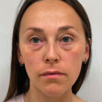 Нижняя блефаропластика - до