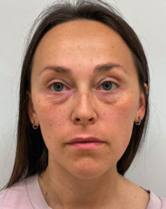 Нижняя блефаропластика - до