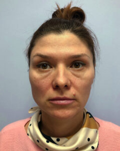 Нижняя блефаропластика - до