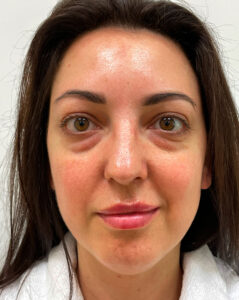 Нижняя блефаропластика - до