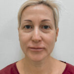 Круговая блефаропластика - до