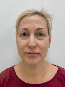 Круговая блефаропластика - до