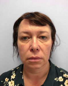 Круговая блефаропластика - до