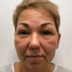 Круговая блефаропластика - до