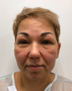 Круговая блефаропластика - до